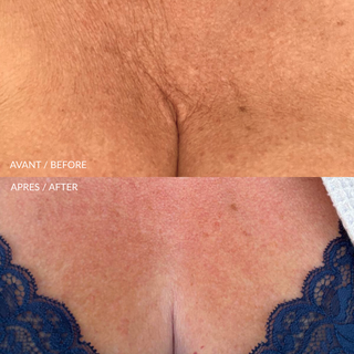 HydraLiss Patch Silicone Cou & Décolleté-Outils Corps-Roll On Jade